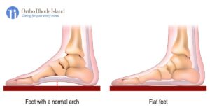 People With Flat Feet Can Still Run Comfortably With the Right Support – Runner’s World