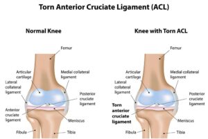 How Long Does It Really Take to Recover from an ACL Tear?