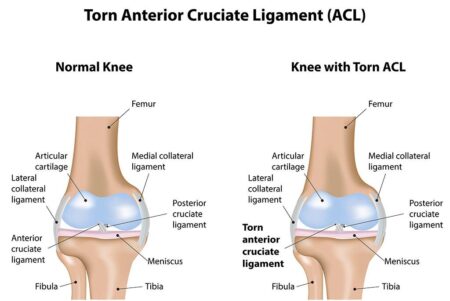How Long Does It Really Take to Recover from an ACL Tear?