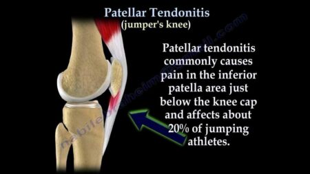 Unlocking Patellar Tendinopathy: Essential Insights for Athletes in Jumping Sports
